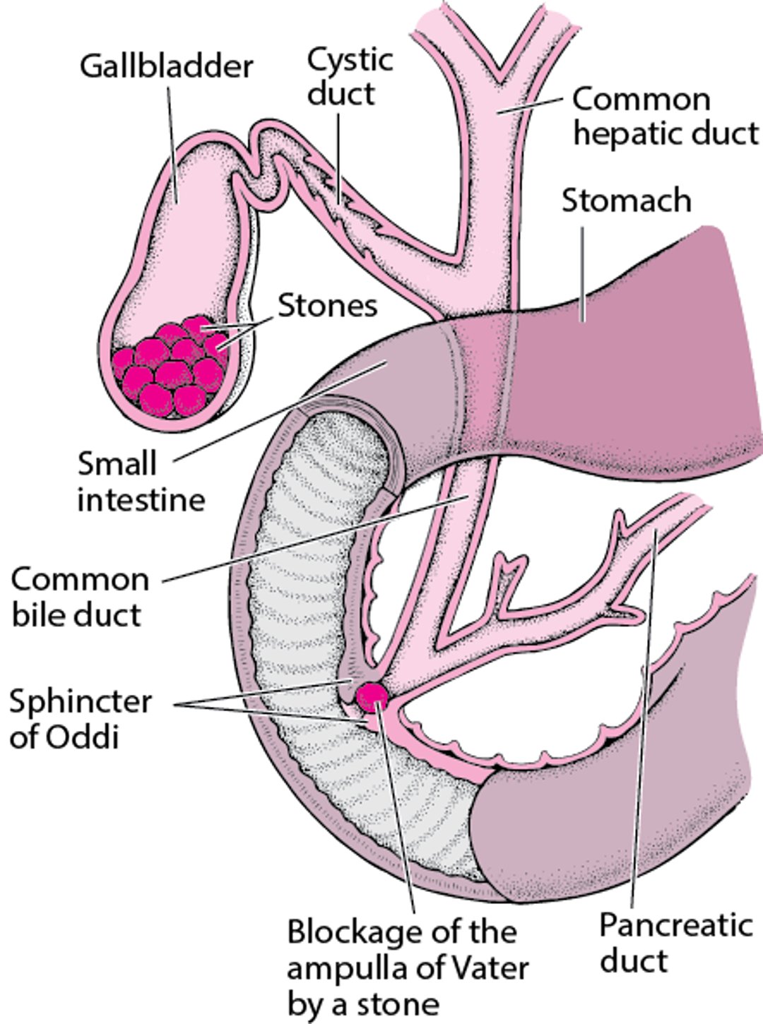 What Are Gallstones?