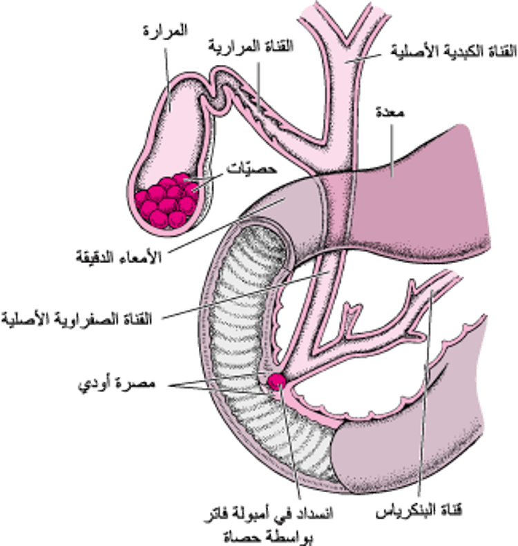 ما هي حُصيَّات المرارة؟