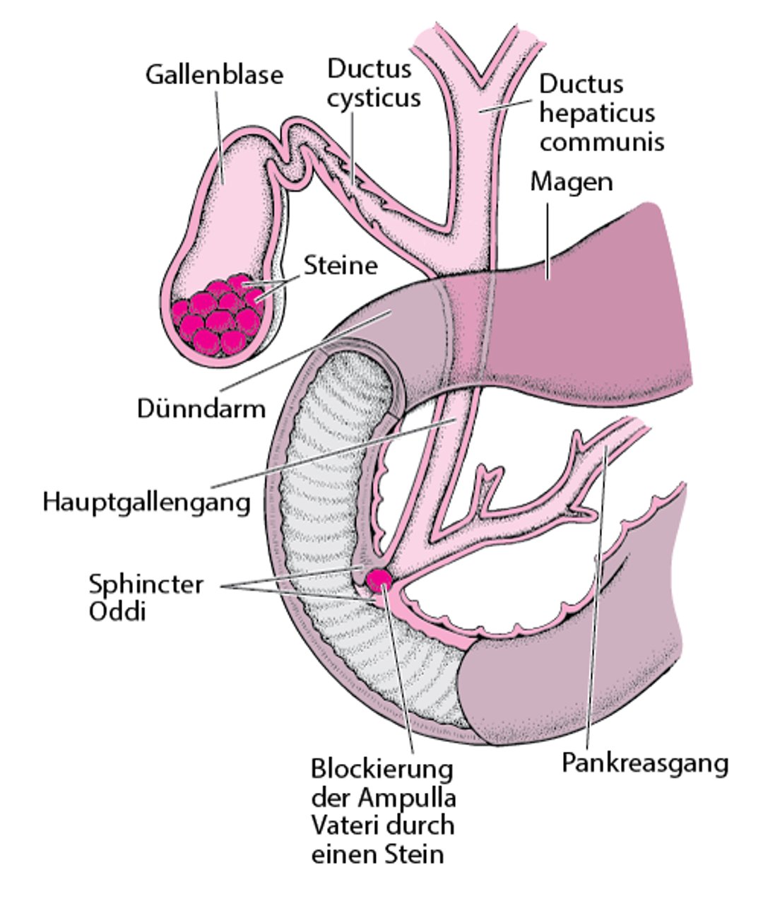 Was sind Gallensteine?
