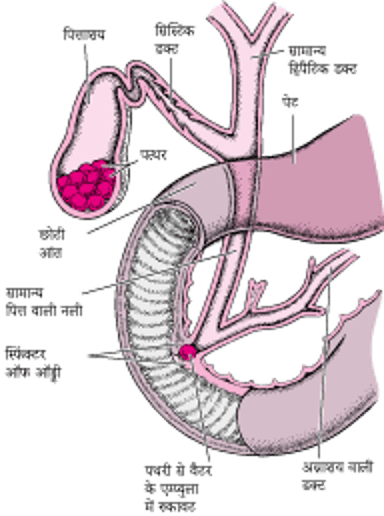 पित्ताशय की पथरी क्या होती है?