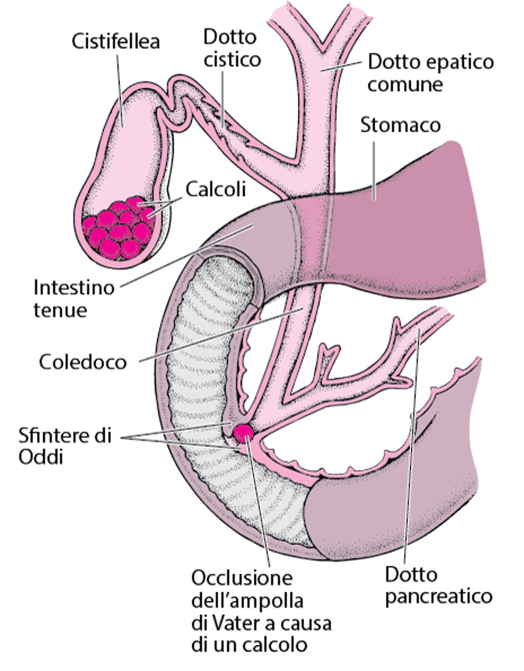 Cosa sono i calcoli biliari?
