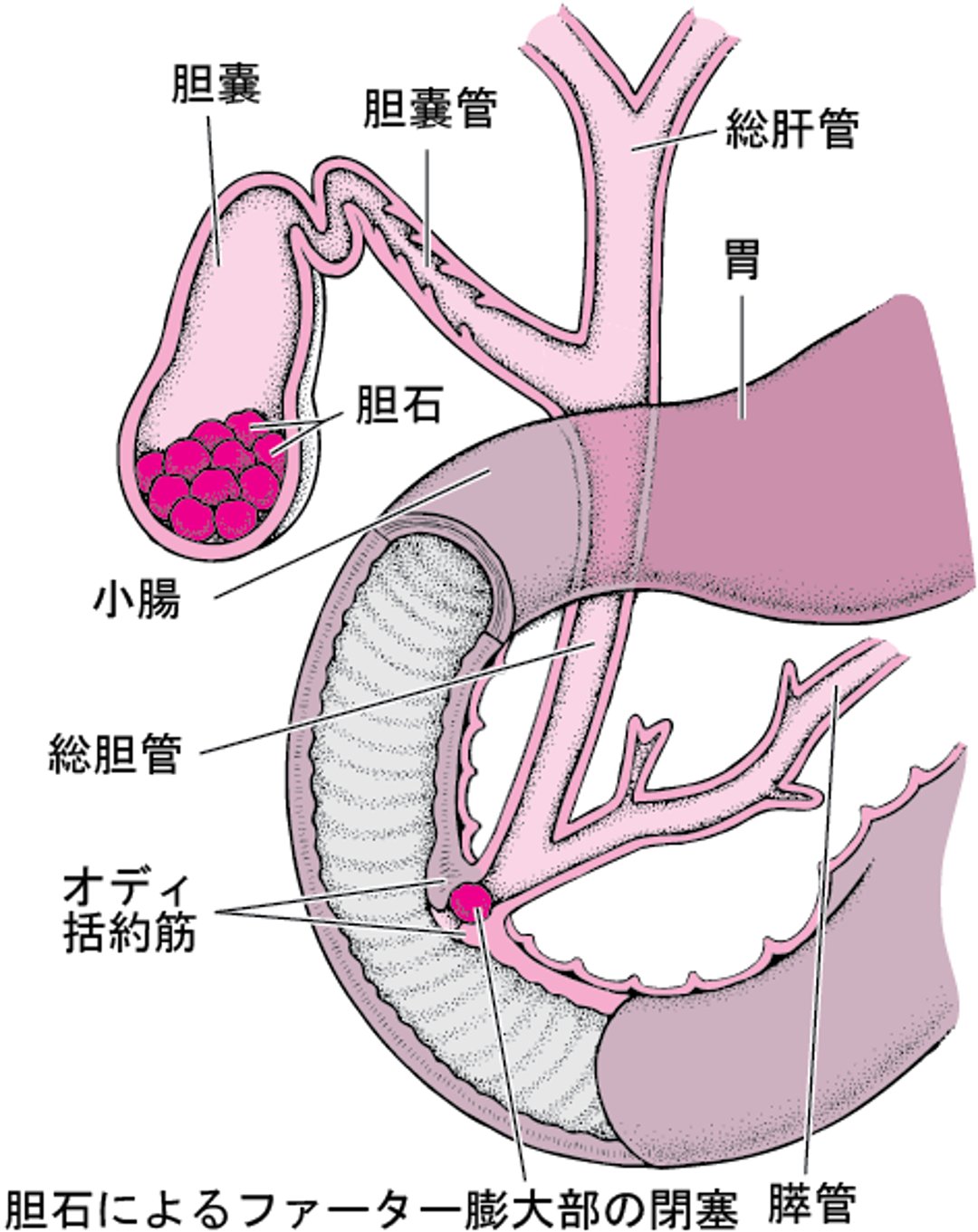 胆石とは何か