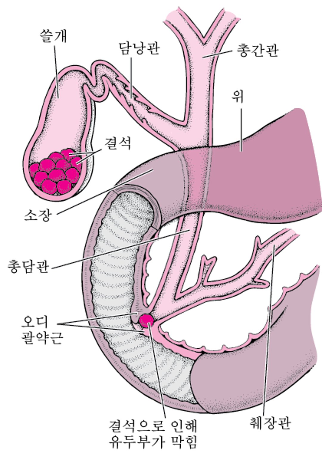 담석이란 무엇입니까?