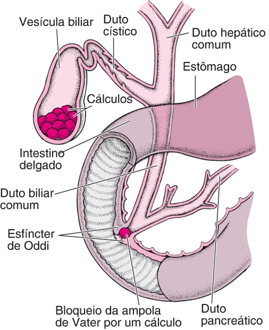 O que são cálculos biliares?