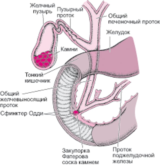 Что такое желчные камни?