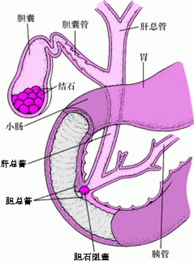 什么是胆结石？