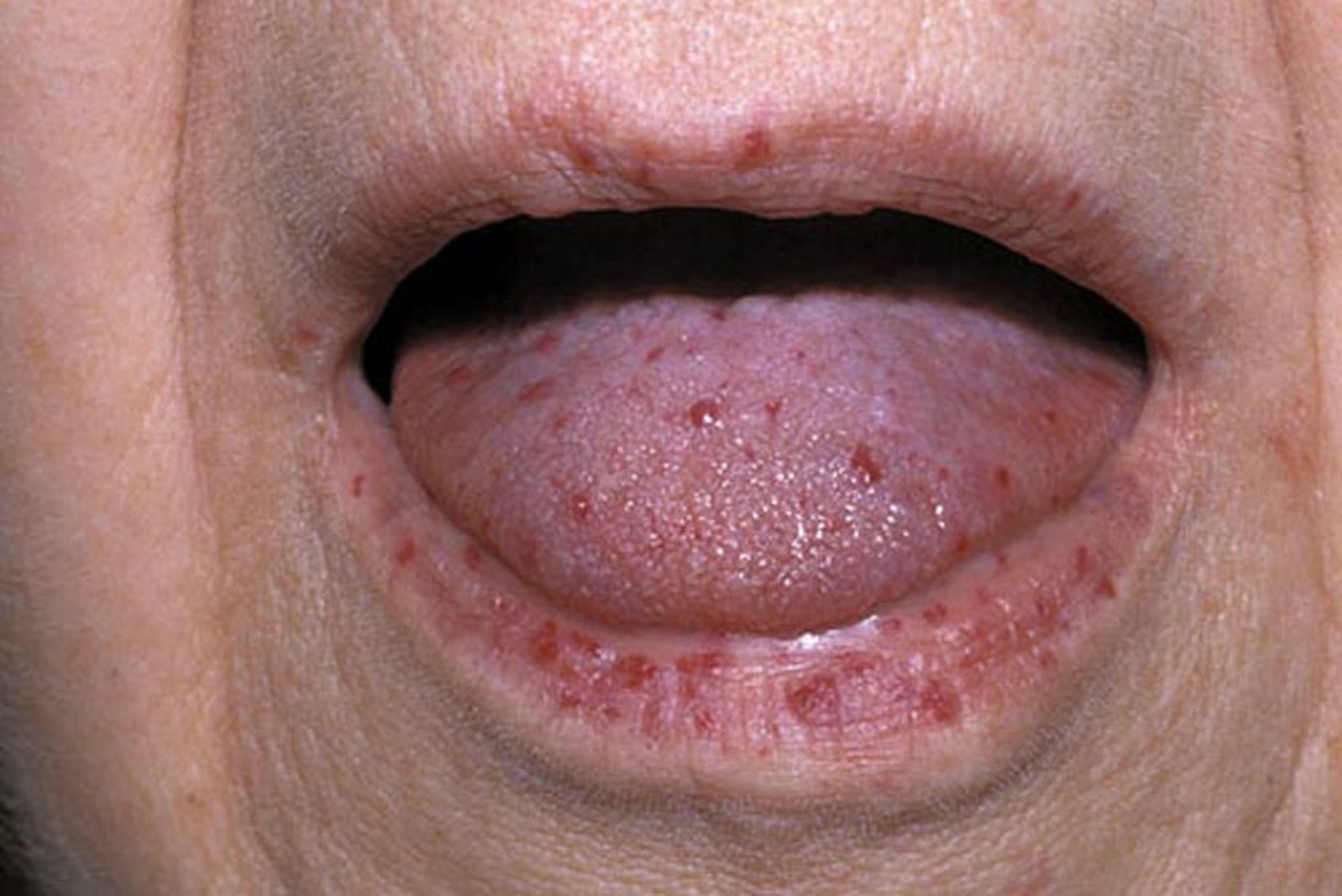 Telangiectasia hemorrágica hereditaria (boca)