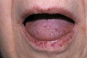Télangiectasie hémorragique héréditaire (bouche)