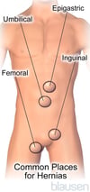 Common Places for Hernias