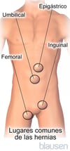 Lugares habituales para las hernias