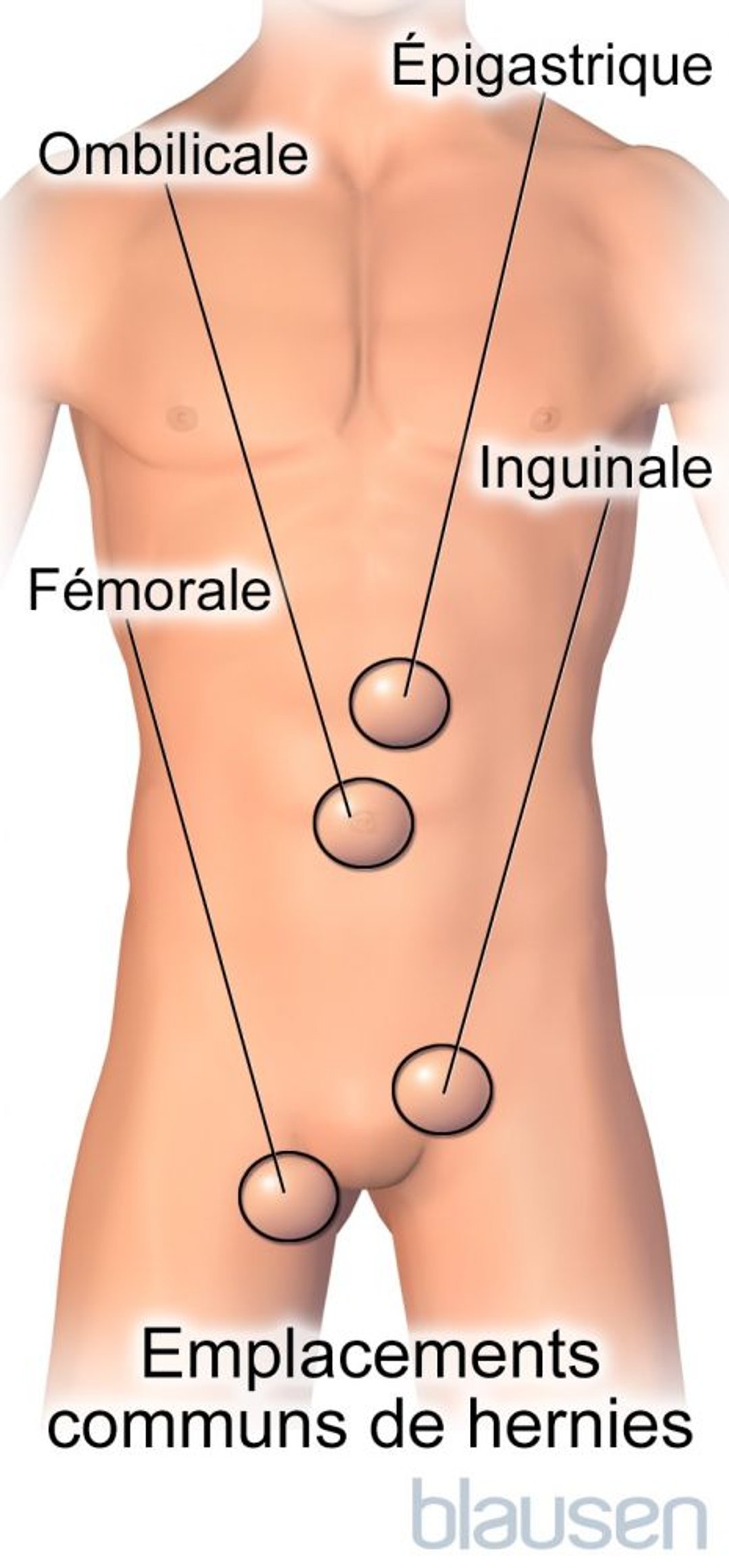 Sites de hernies fréquents