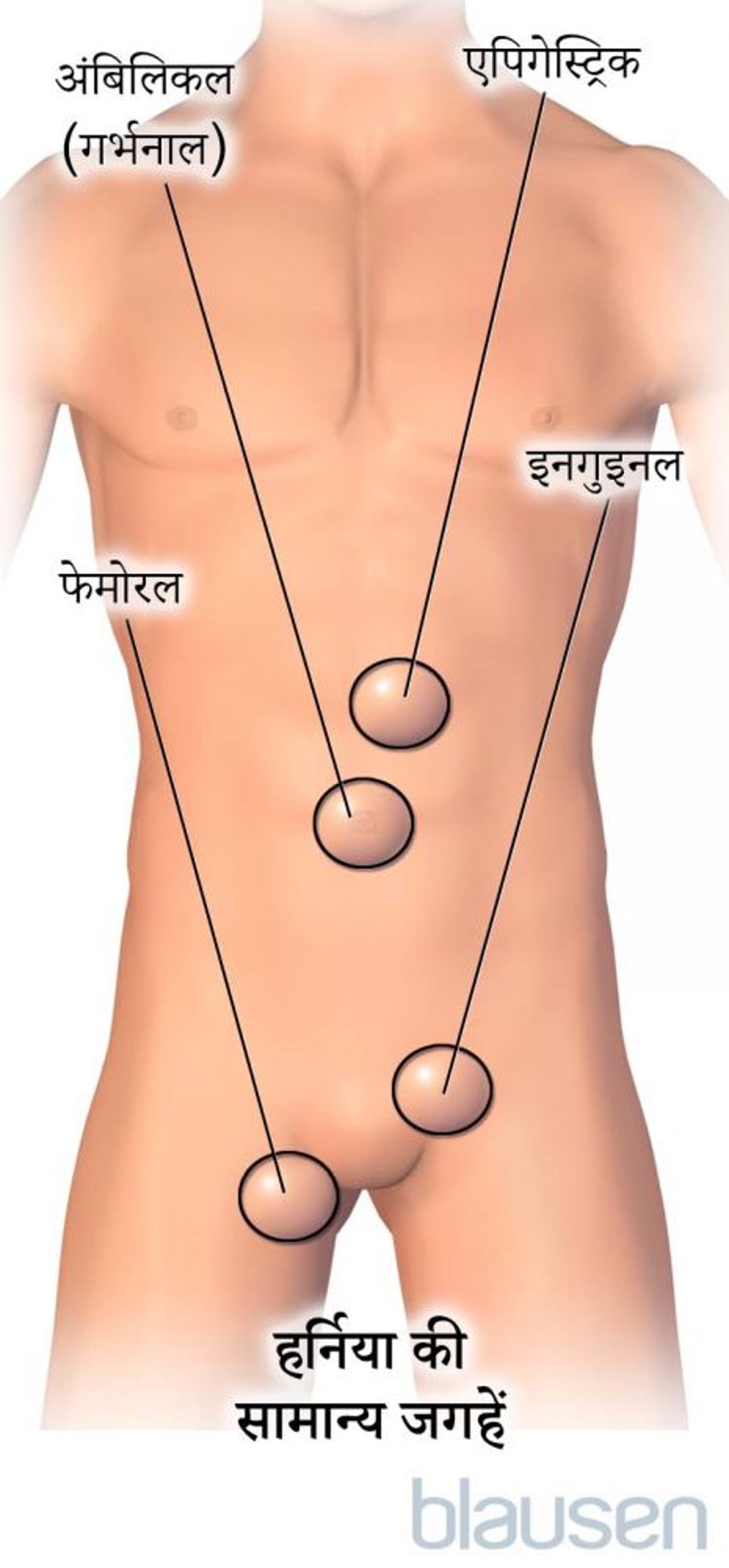 हर्निया के लिए सामान्य स्थान