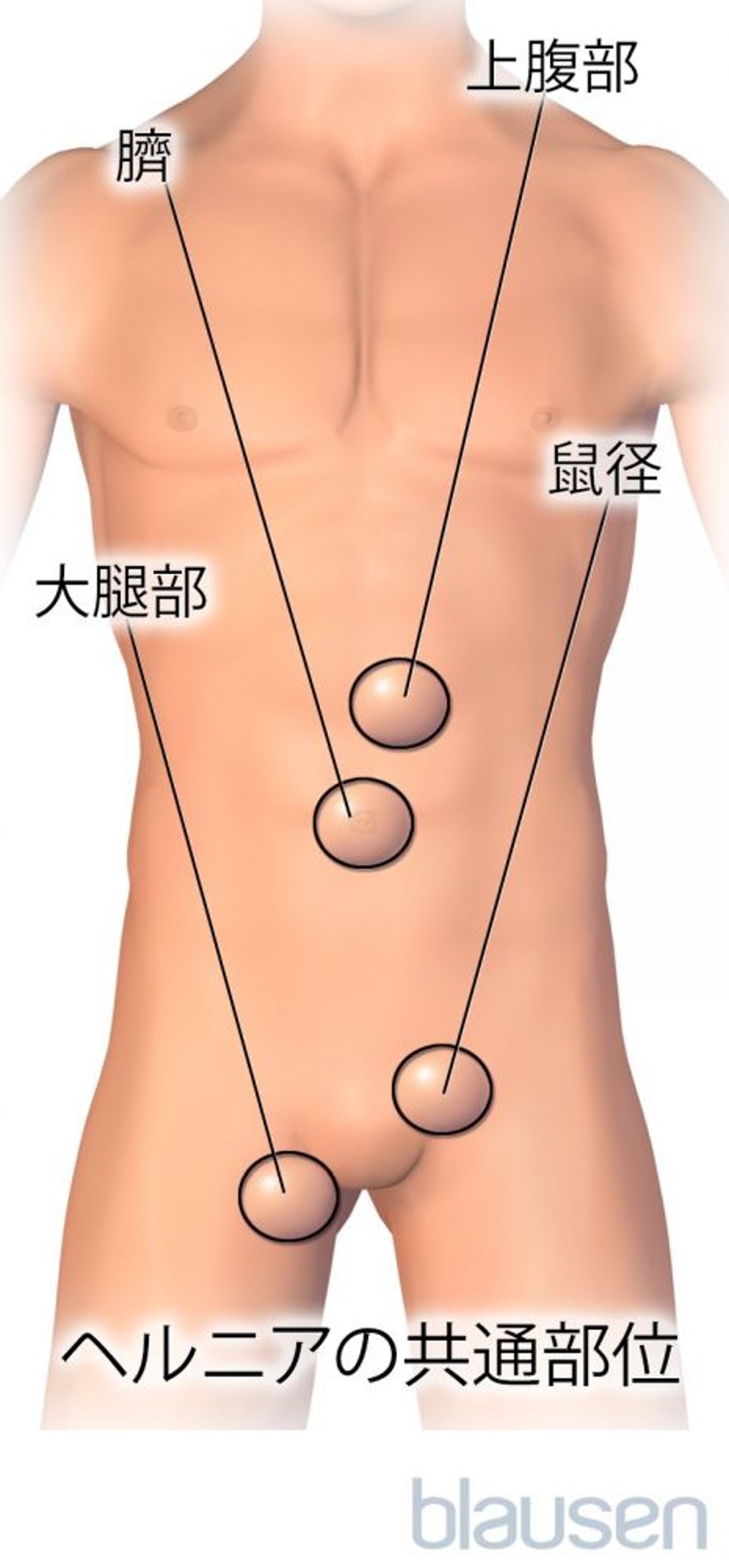 ヘルニアがよくみられる<ruby >場所<rt >ばしょ</rt></ruby>