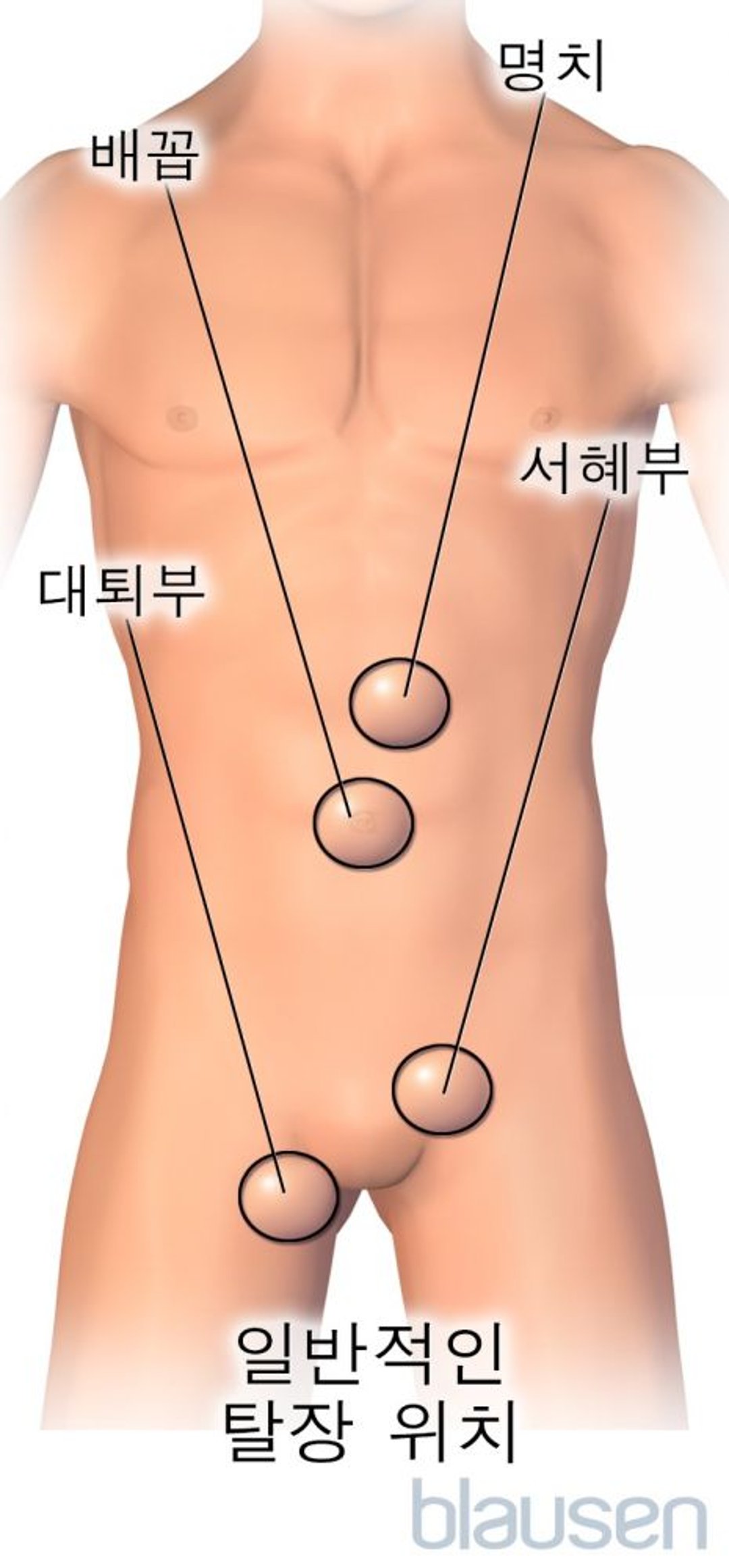 일반적인 탈장 위치