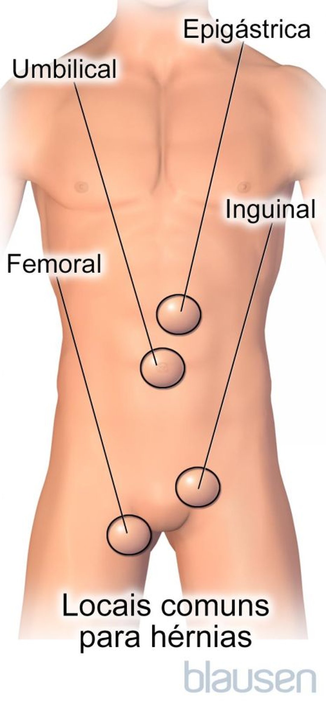 Locais comuns para hérnias