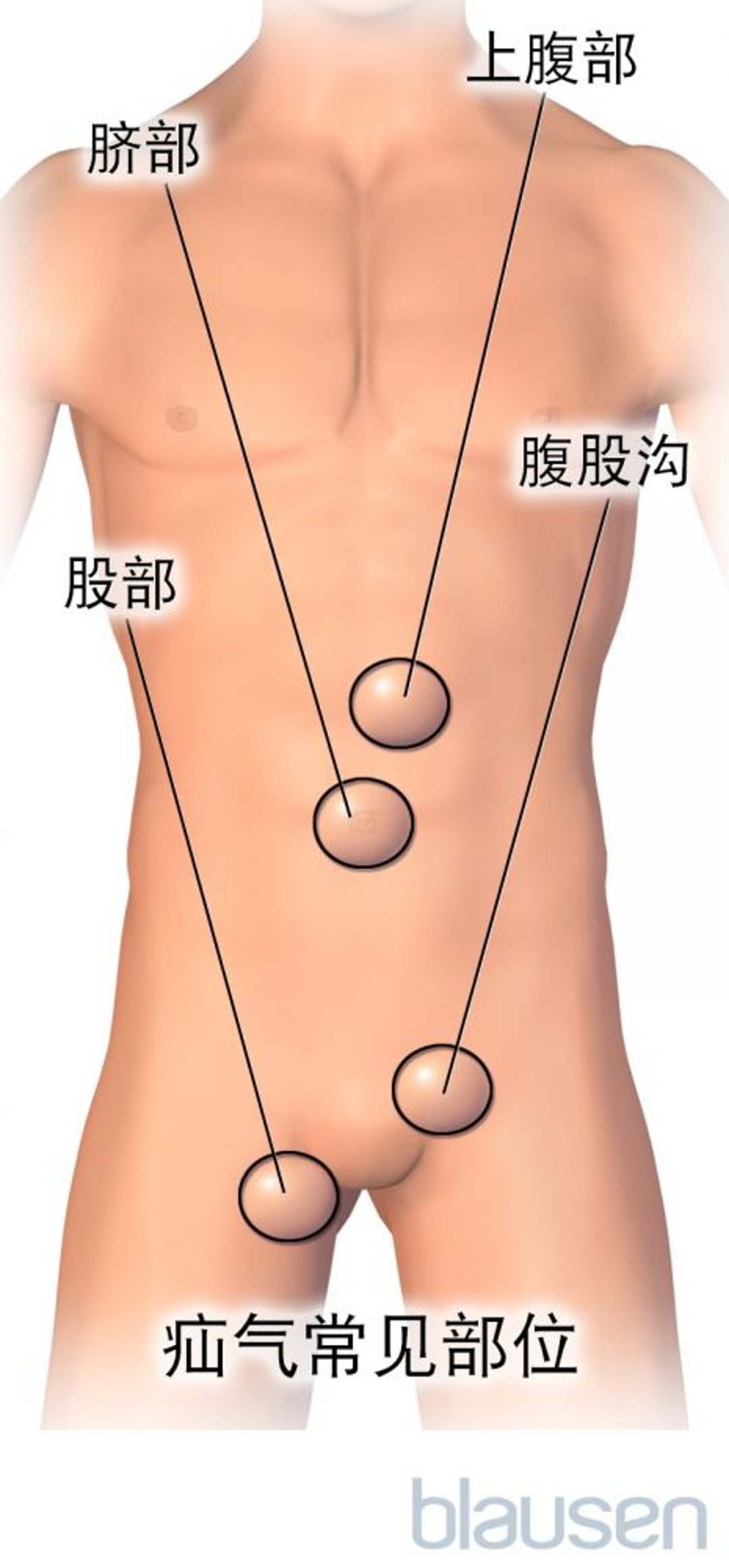 疝气常见部位