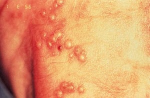 Infection par le virus herpes simplex chez un nouveau-né