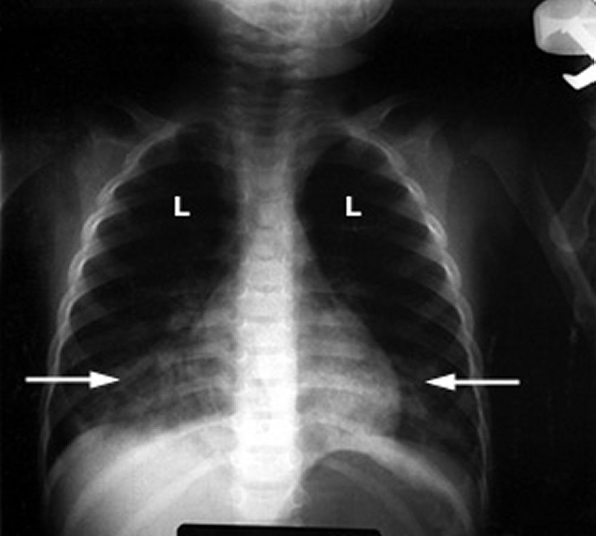 Pneumonie chimique causée par l’inhalation d’hydrocarbures