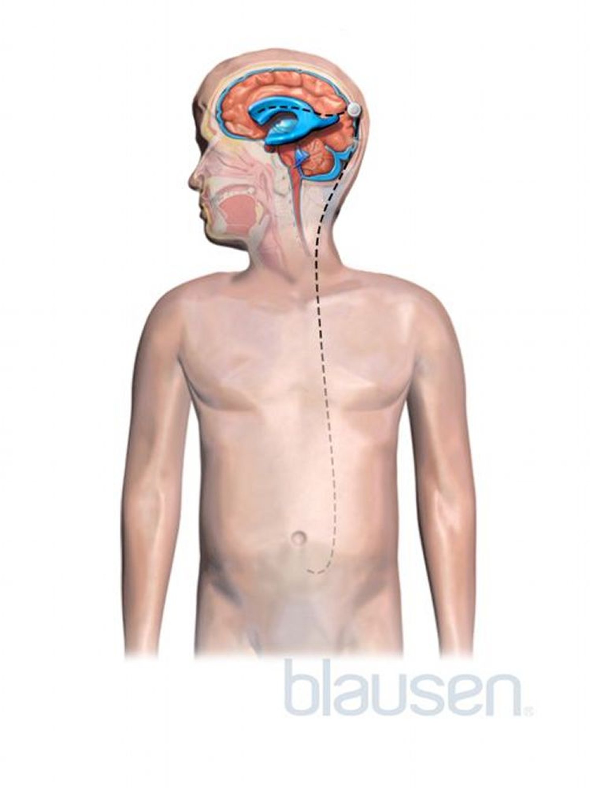 Shunt bei einem Kind mit Hydrozephalus