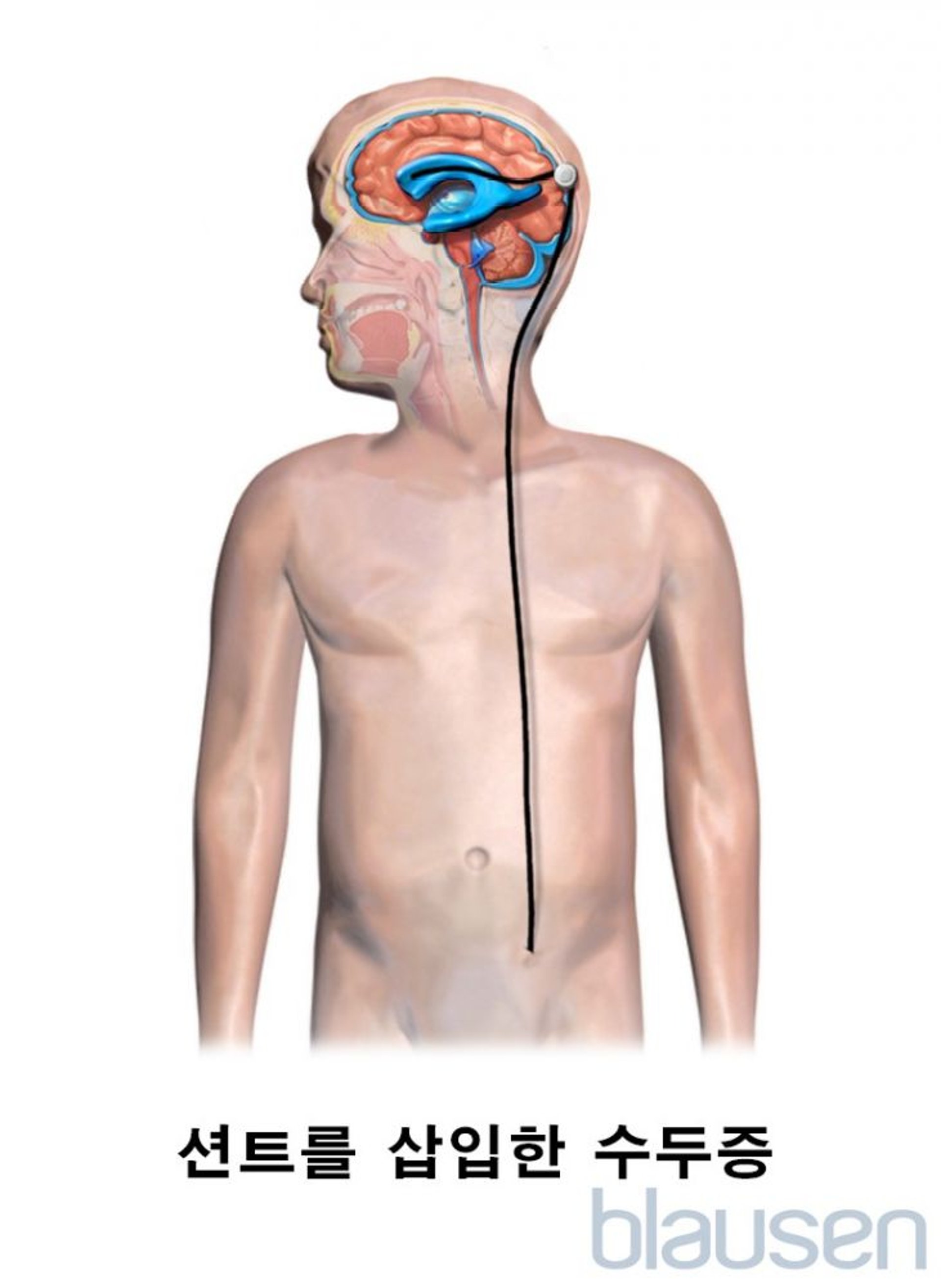 수두증 소아에서의 션트