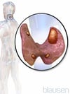 Parathyroid Adenoma