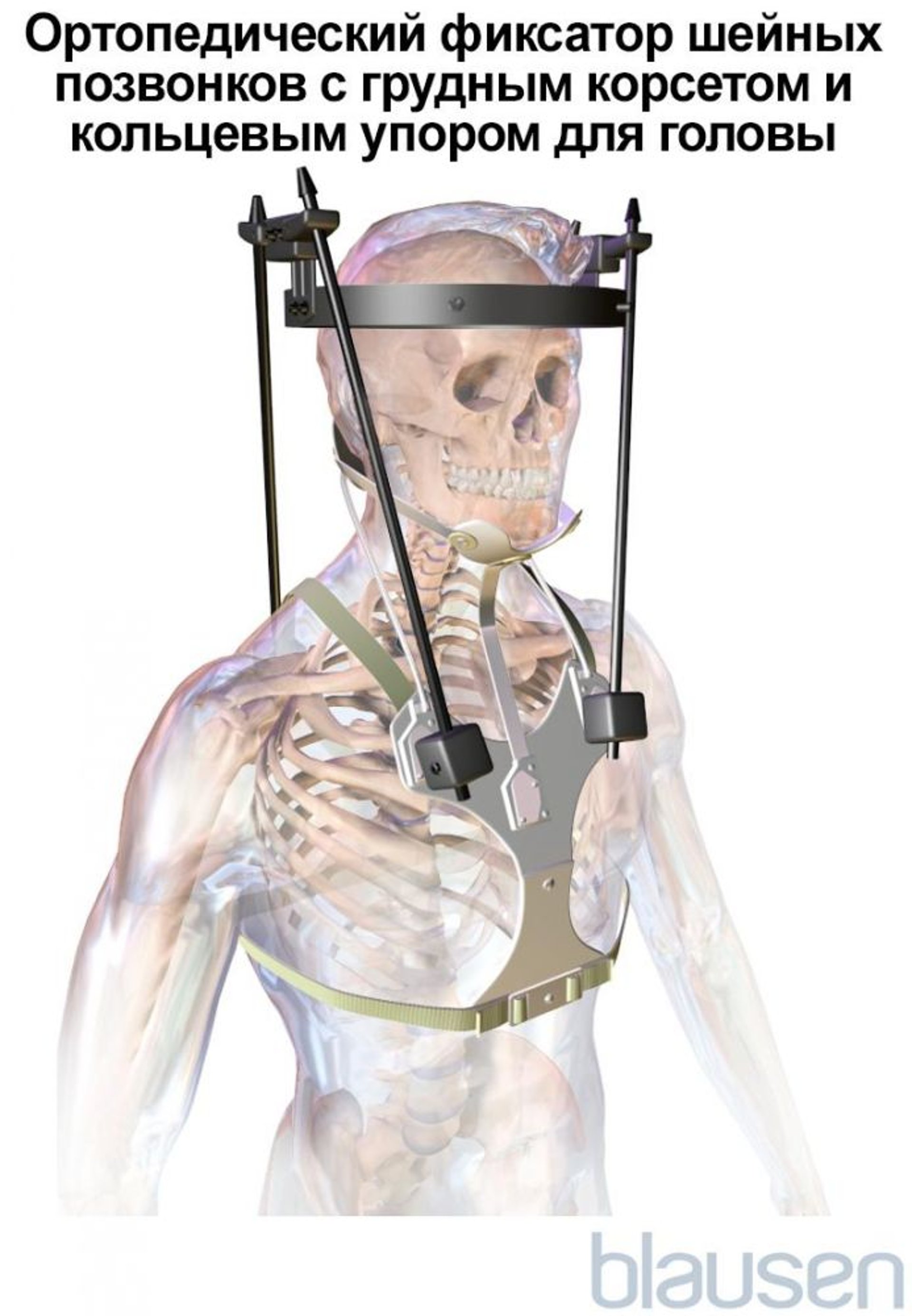 Ортопедический фиксатор шейных позвонков с грудным корсетом и кольцевым упором для головы