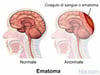 Ematoma