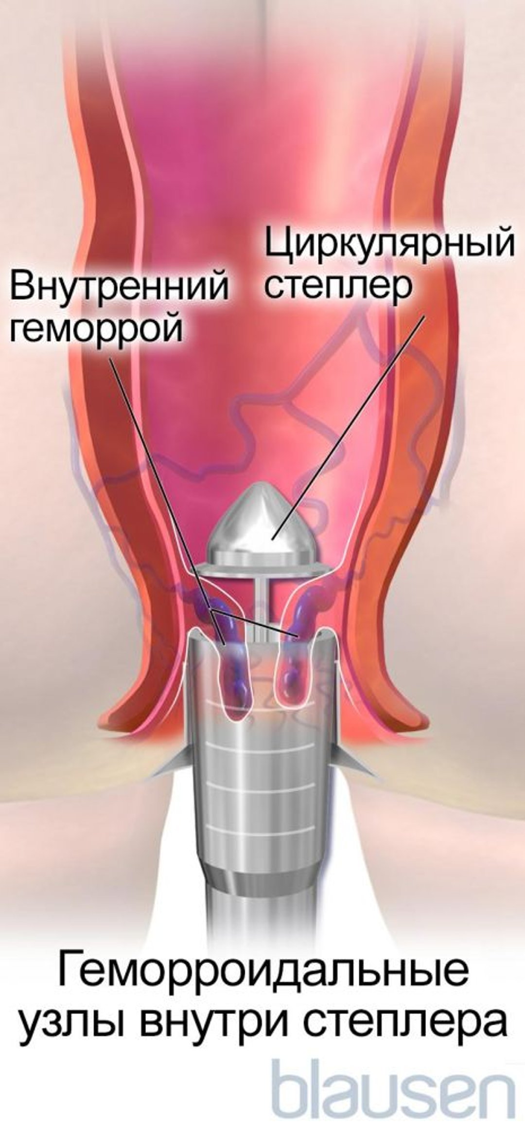 Геморроидопексия