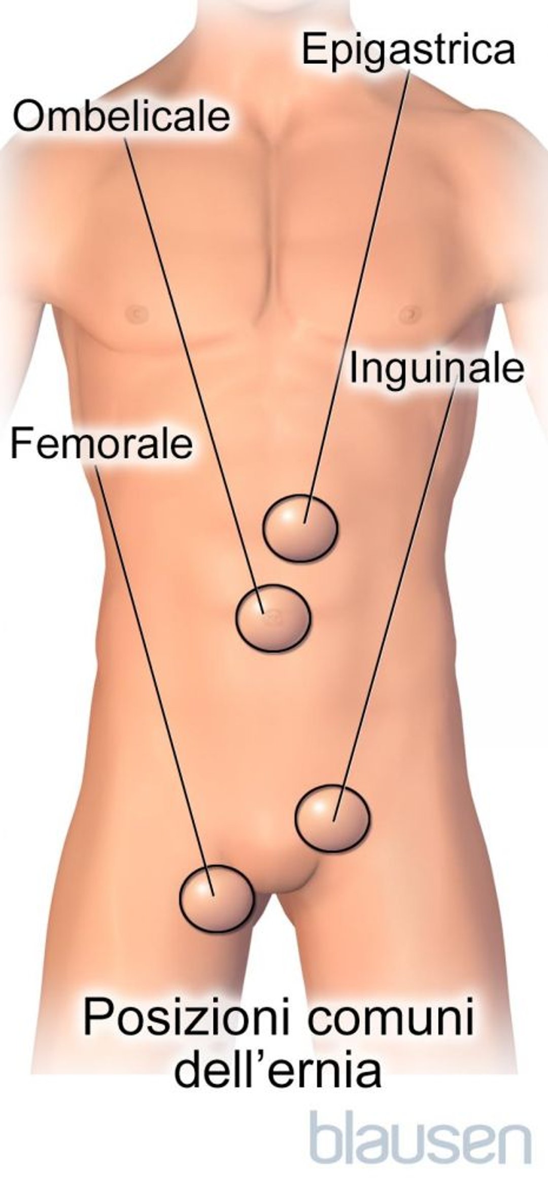 Posizioni comuni dell'ernia
