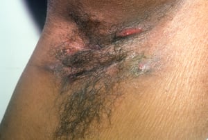 Hidradenitis supurativa