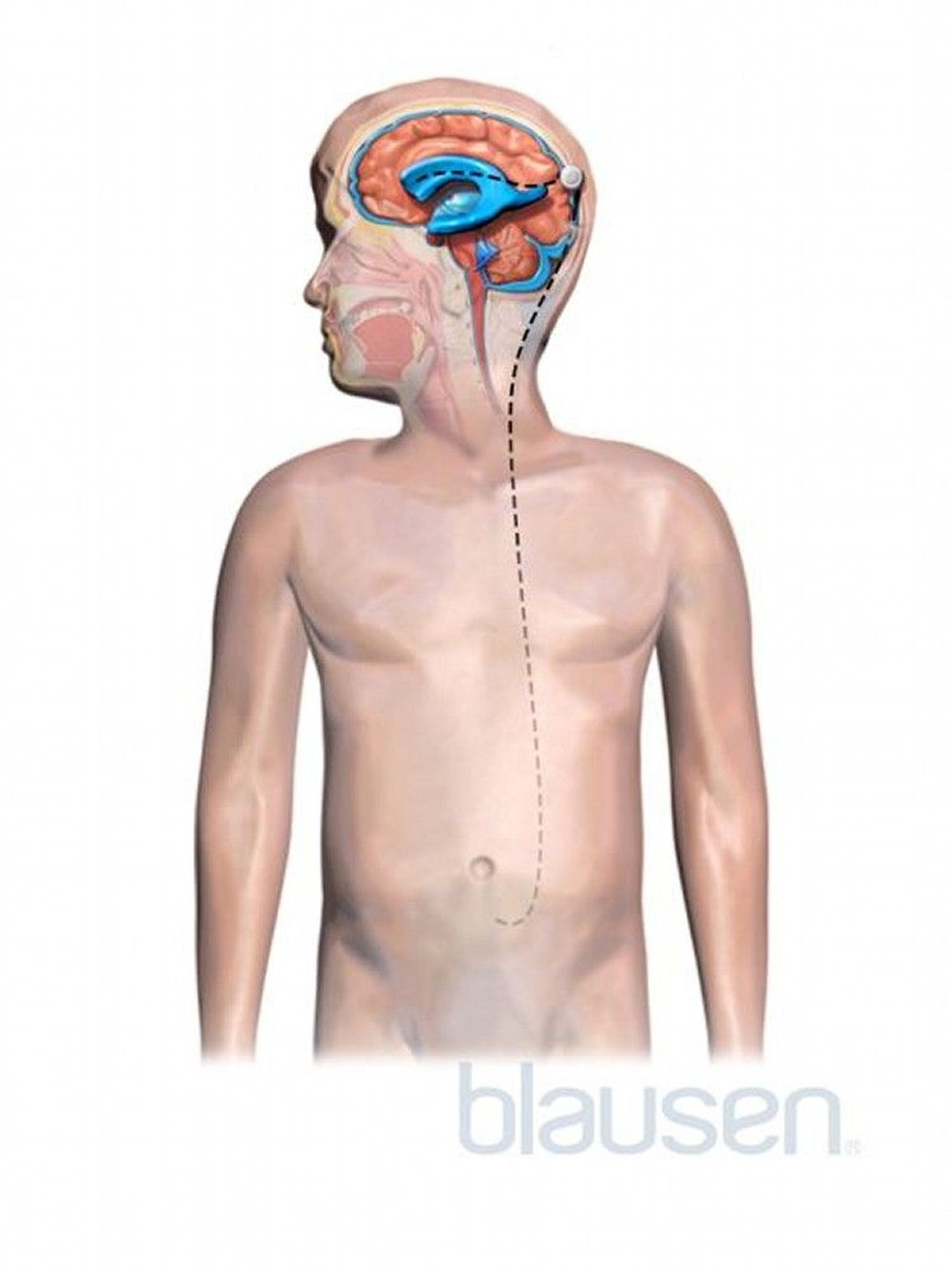 水頭症の小児におけるシャント