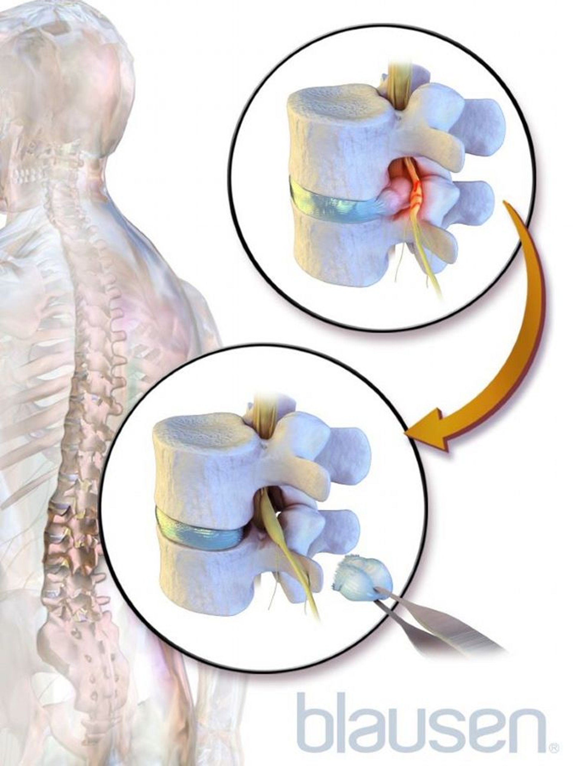 استئصال القرص Diskectomy