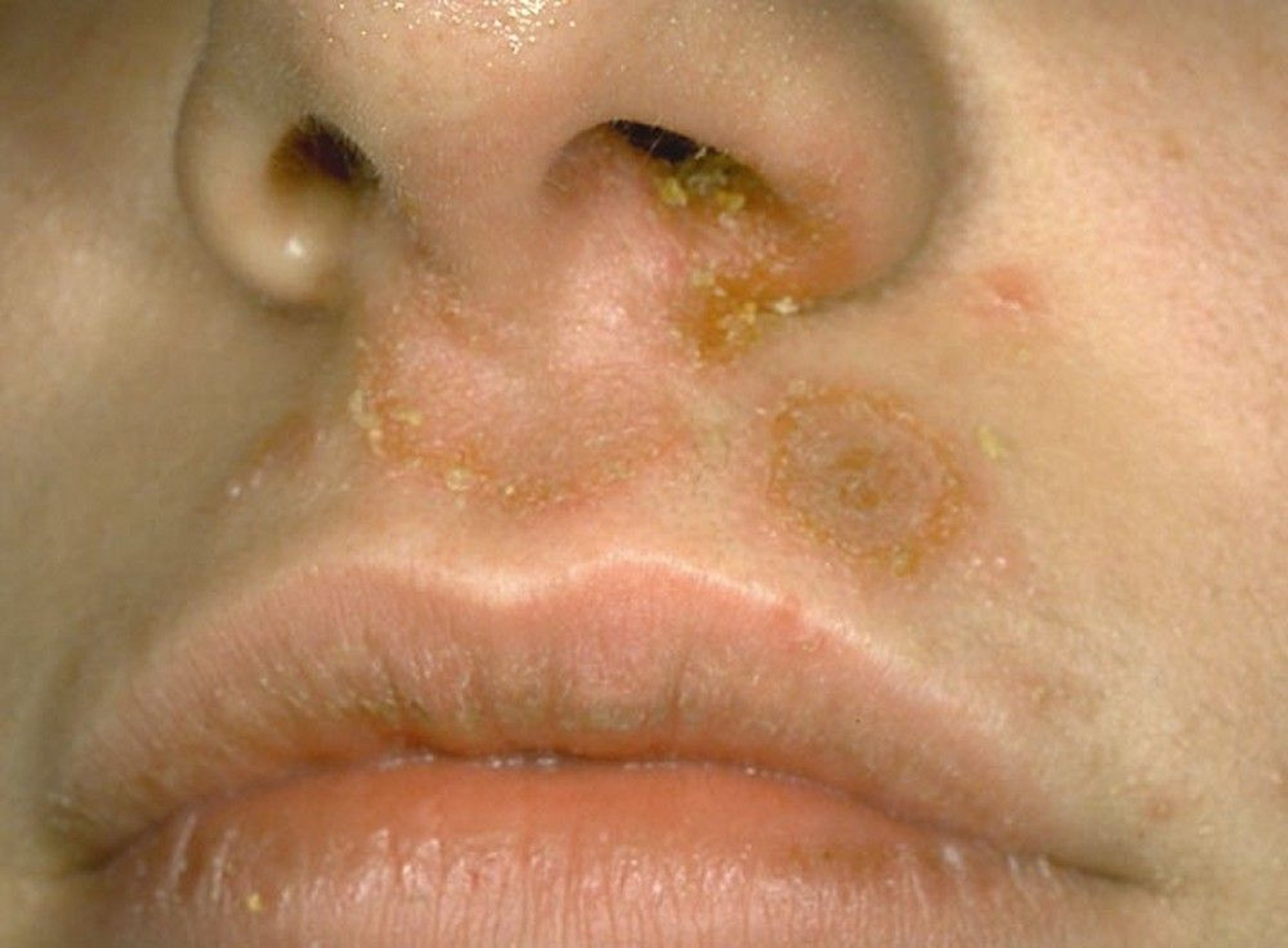 Impetigo