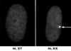 Inactive X Chromosome