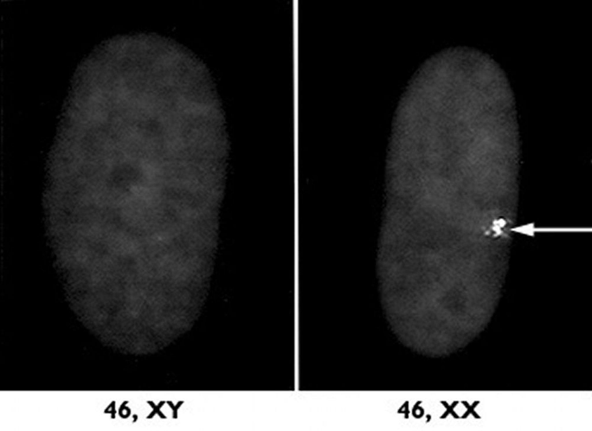 Inactivation du chromosome X