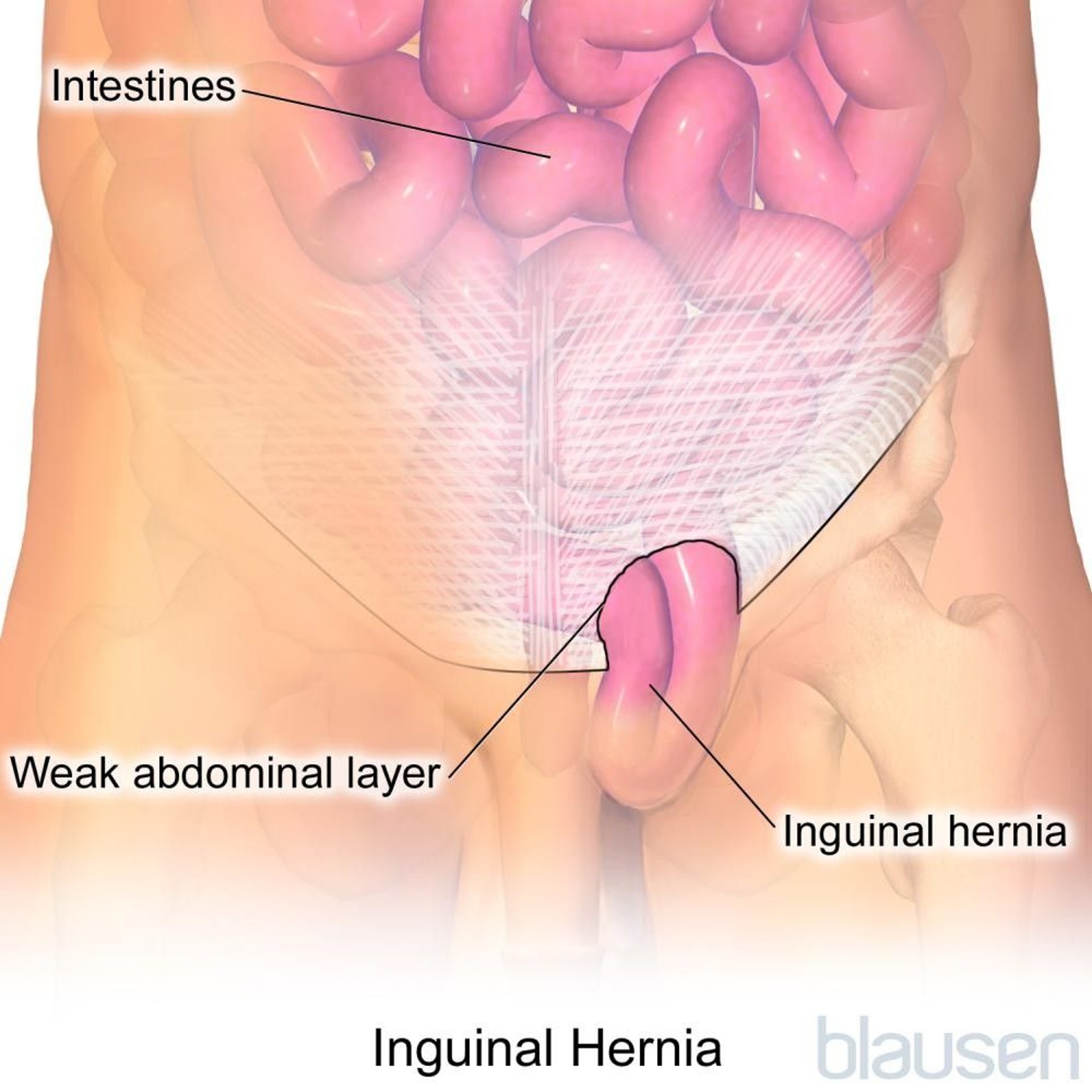 Inguinal Hernia