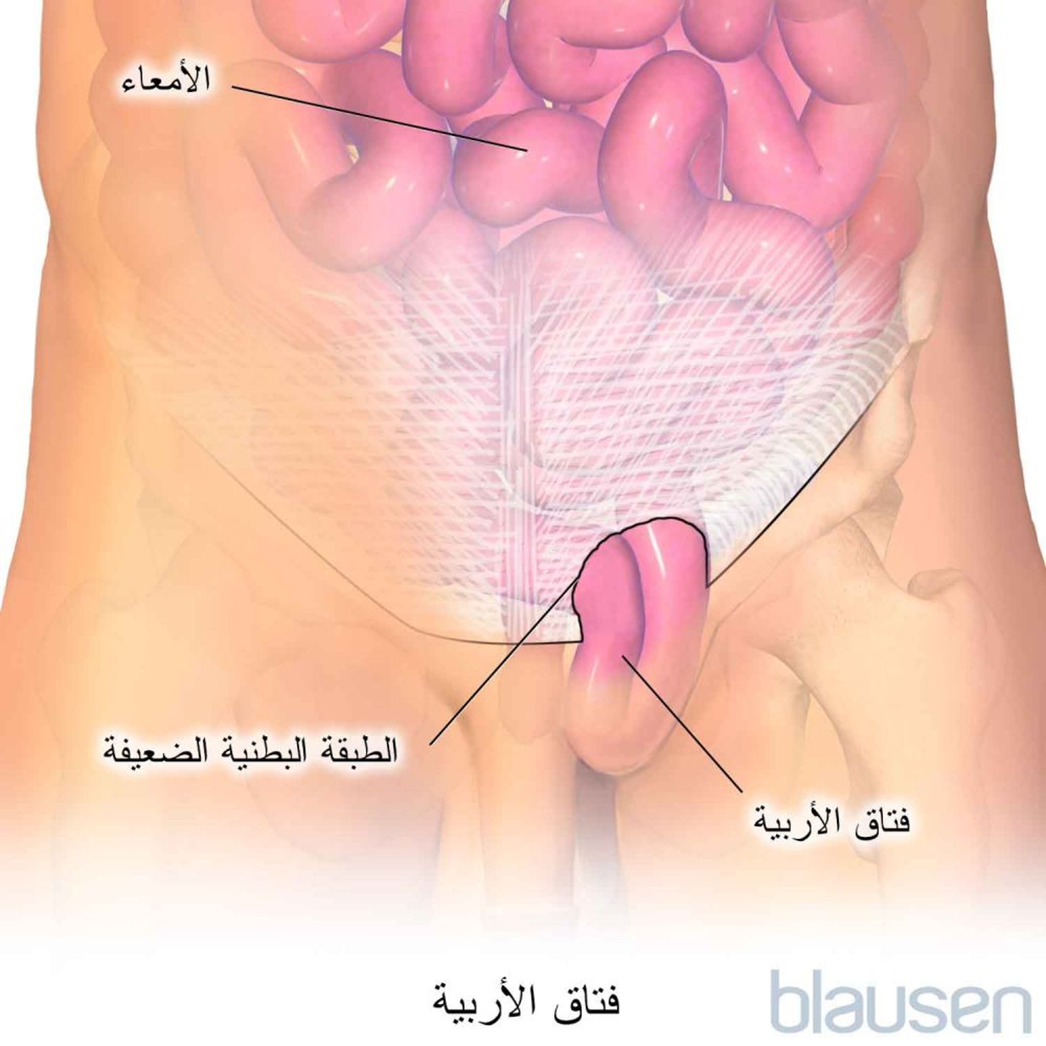 الفتق الأربي