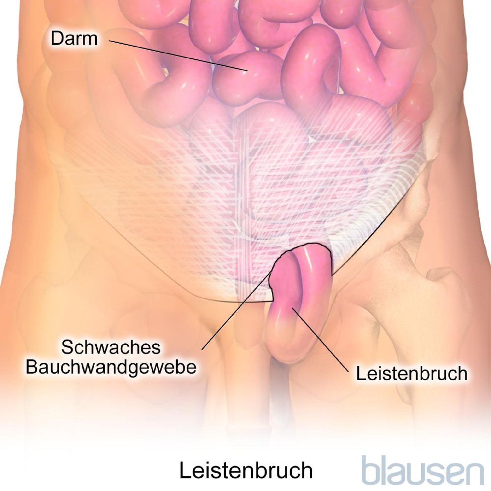 Leistenbruch