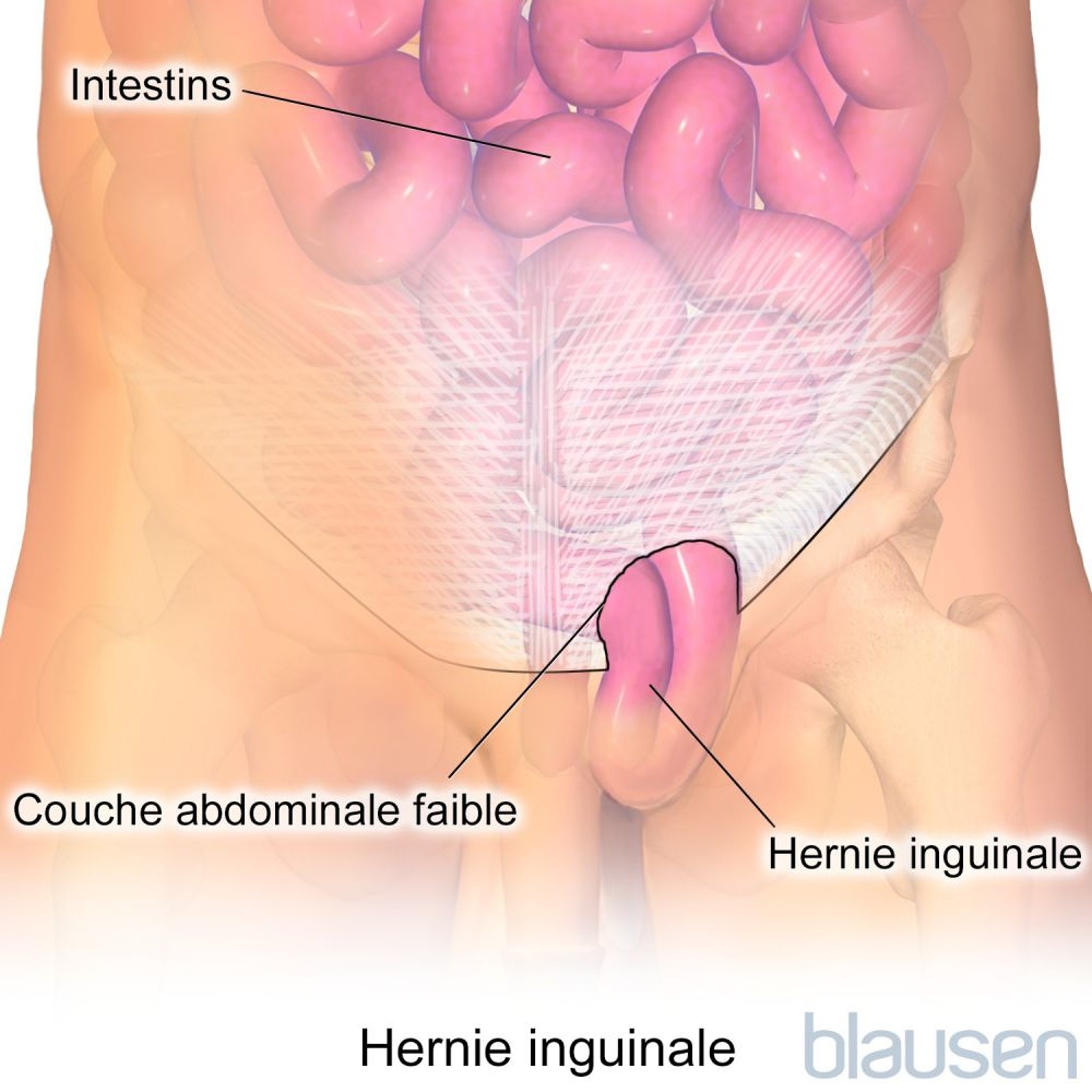 Hernie inguinale