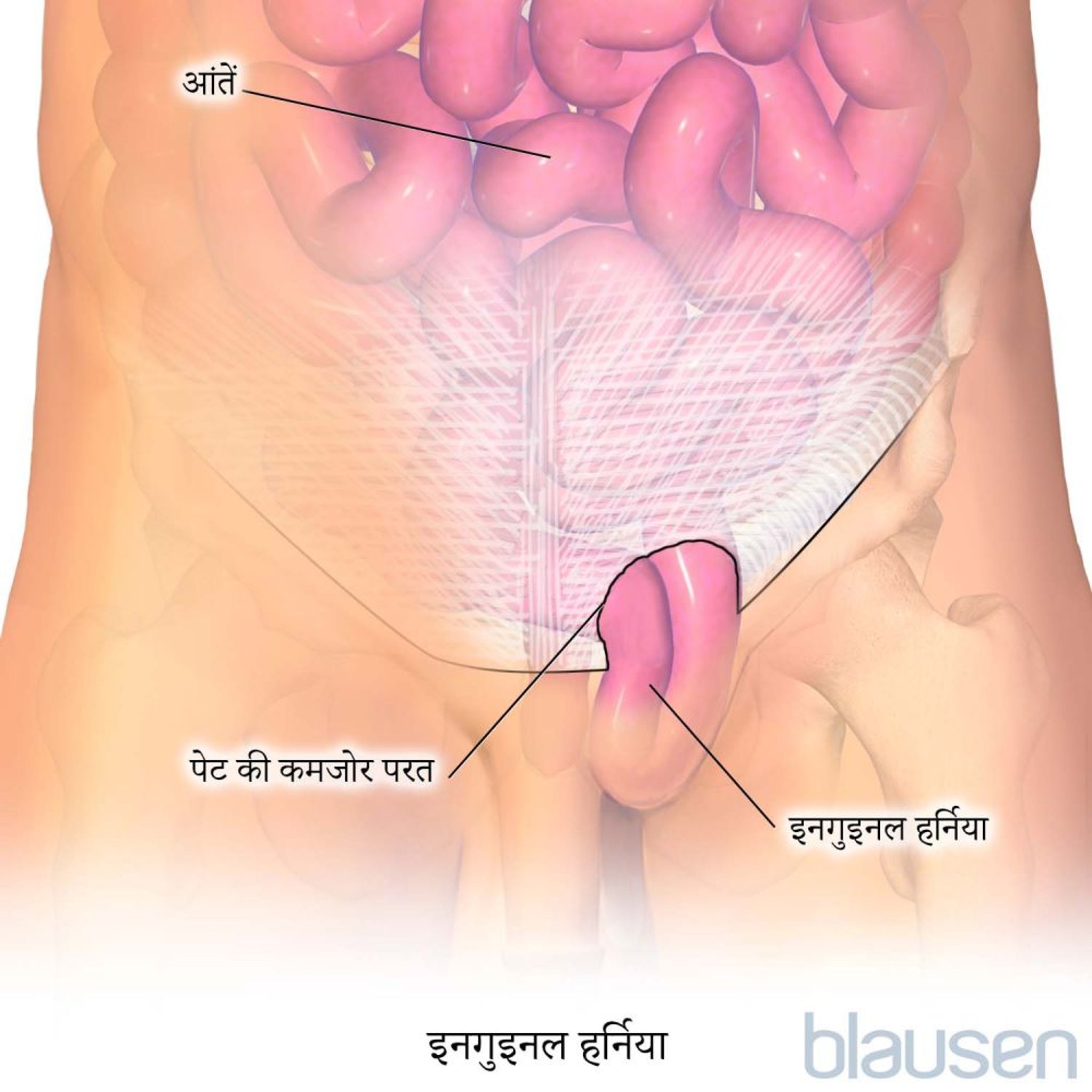 इनगुइनल हर्निया