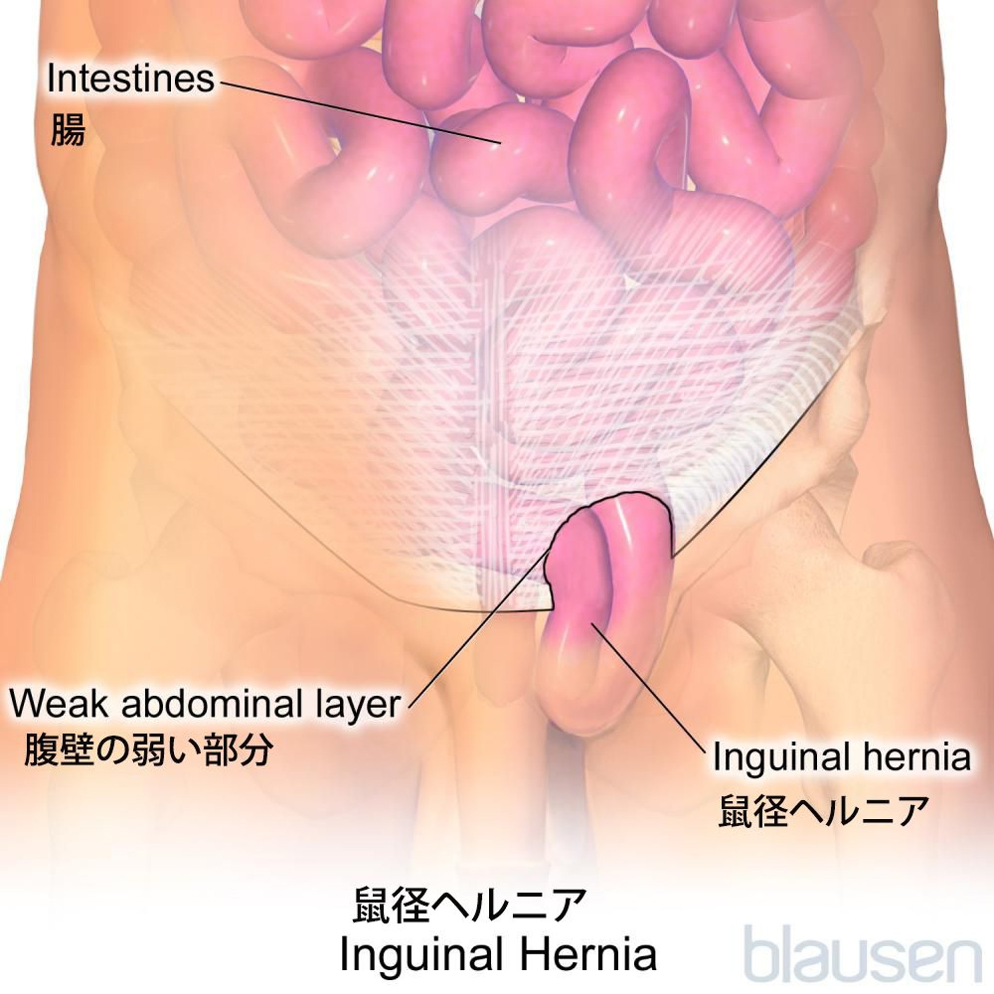 <ruby >鼠径<rt >そけい</rt></ruby>ヘルニア
