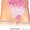 Hérnia inguinal