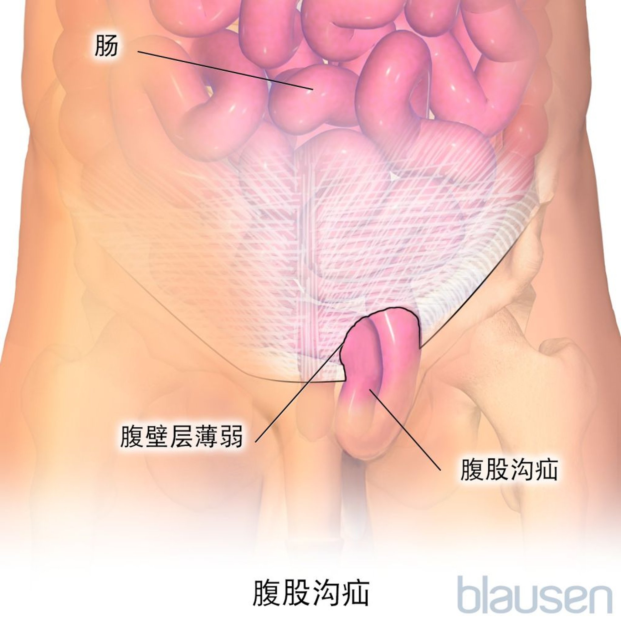 腹股沟疝