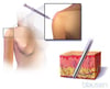 Contraceptive Injection Under the Skin