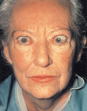 Gejala Mata pada Penyakit Graves