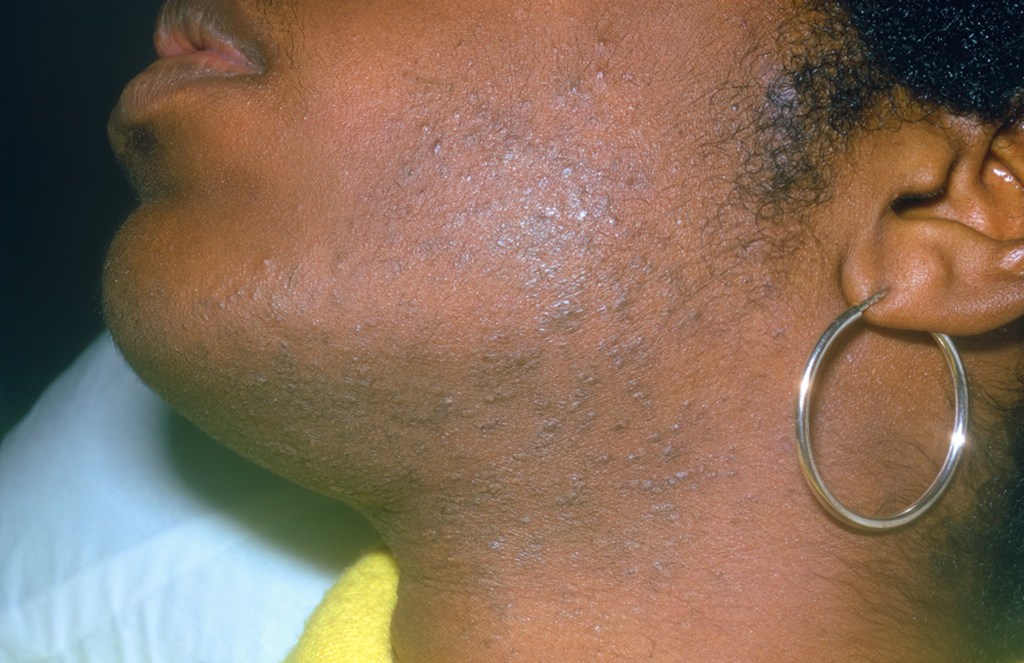 Pseudofolliculitis Barbae