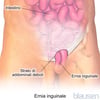 Ernia inguinale