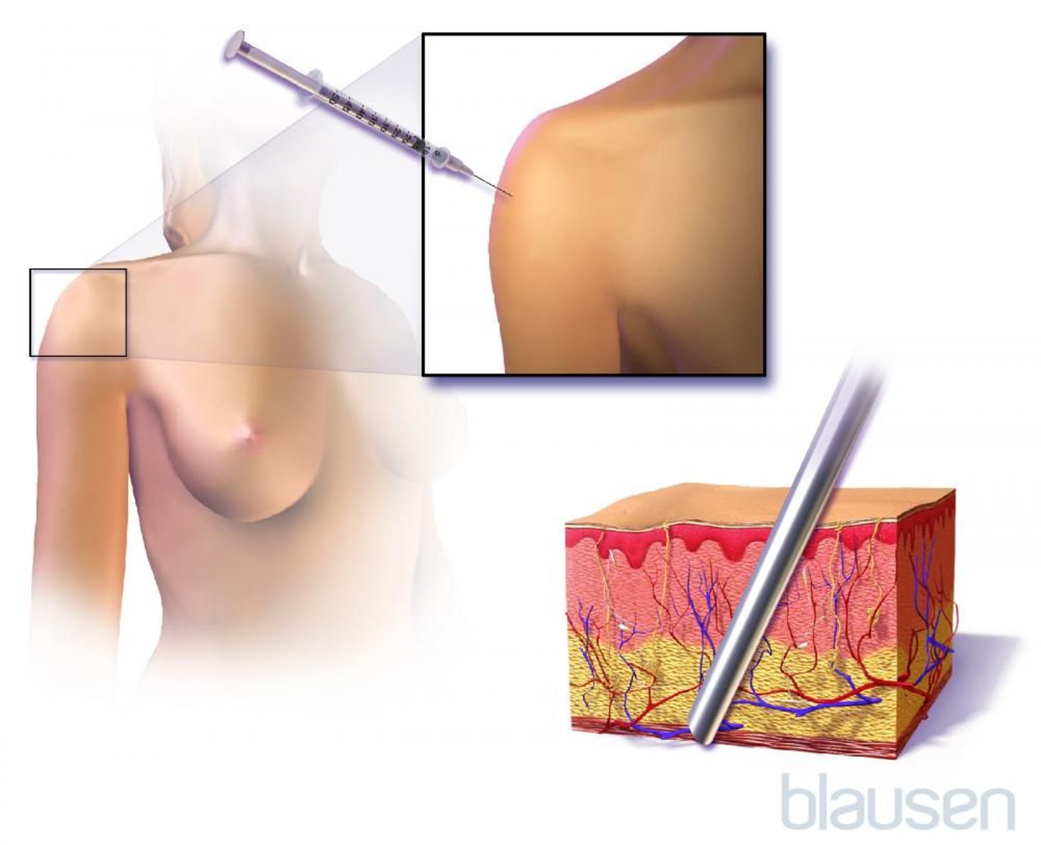 Iniezione contraccettiva sottocutanea