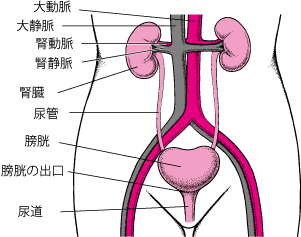尿路結石（腎結石）