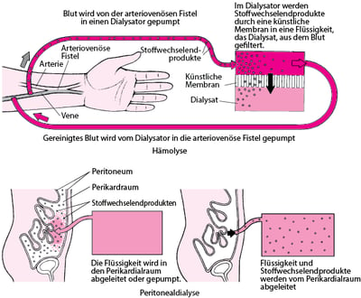 Hämodialyse und Peritonealdialyse im Vergleich